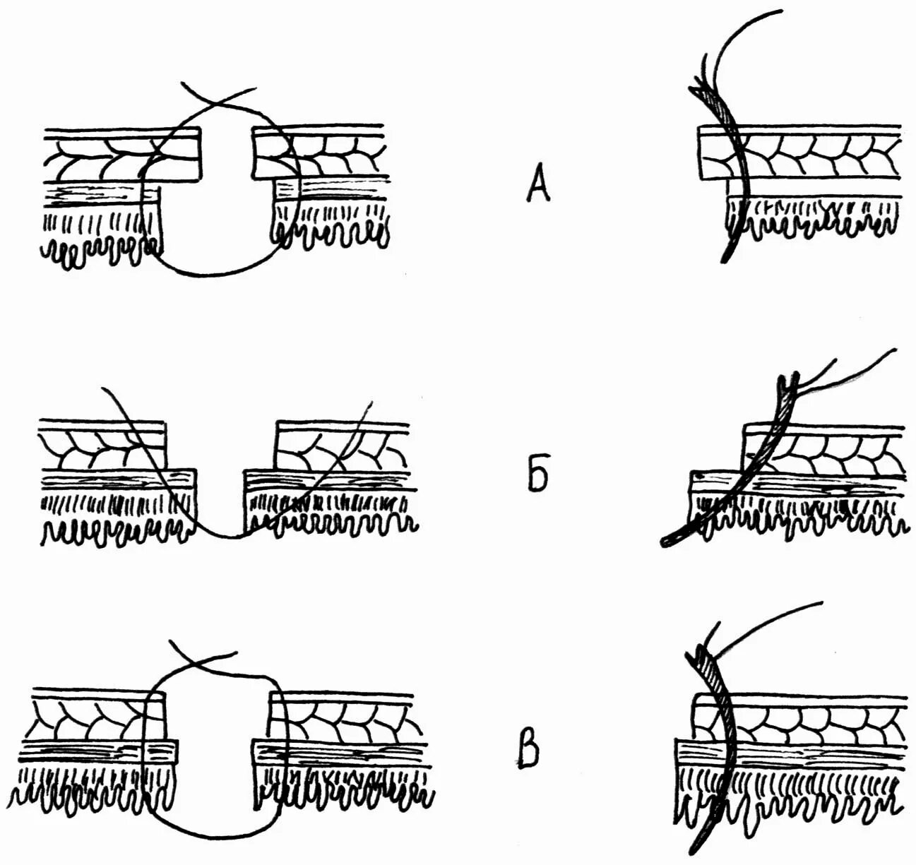 Стерильный шов. Трехрядный кишечный шов. Однорядный непрерывный кишечный шов. Однорядный и двухрядный кишечный шов.