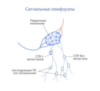 Операция удаления лимфатического узла