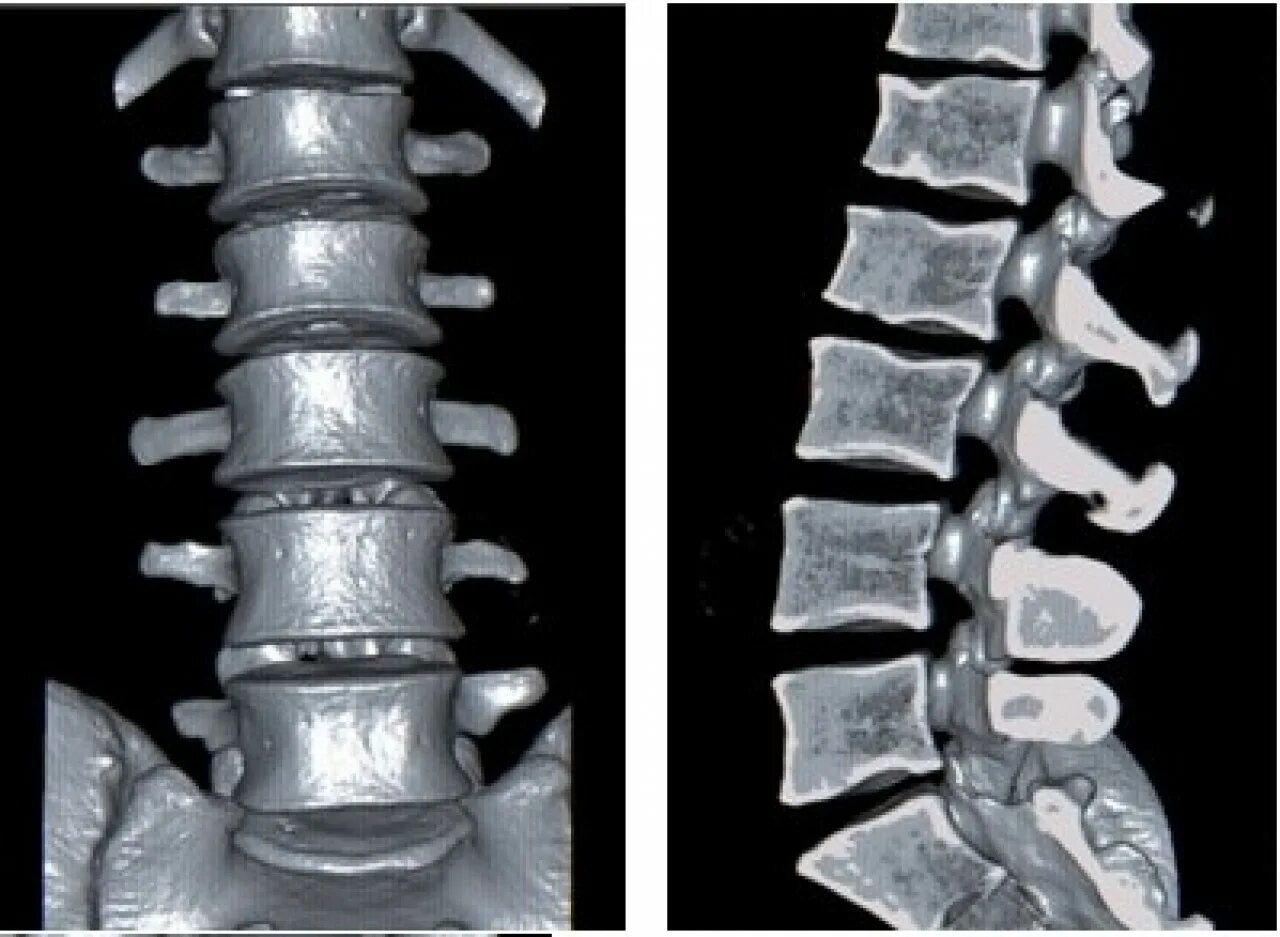 Крестец позвонков рентген. Кт пояснично-крестцового отдела. Рентген поясничного отдела с функциональными пробами. Функциональные пробы поясничного отдела позвоночника рентген. Можно делать кт позвоночника