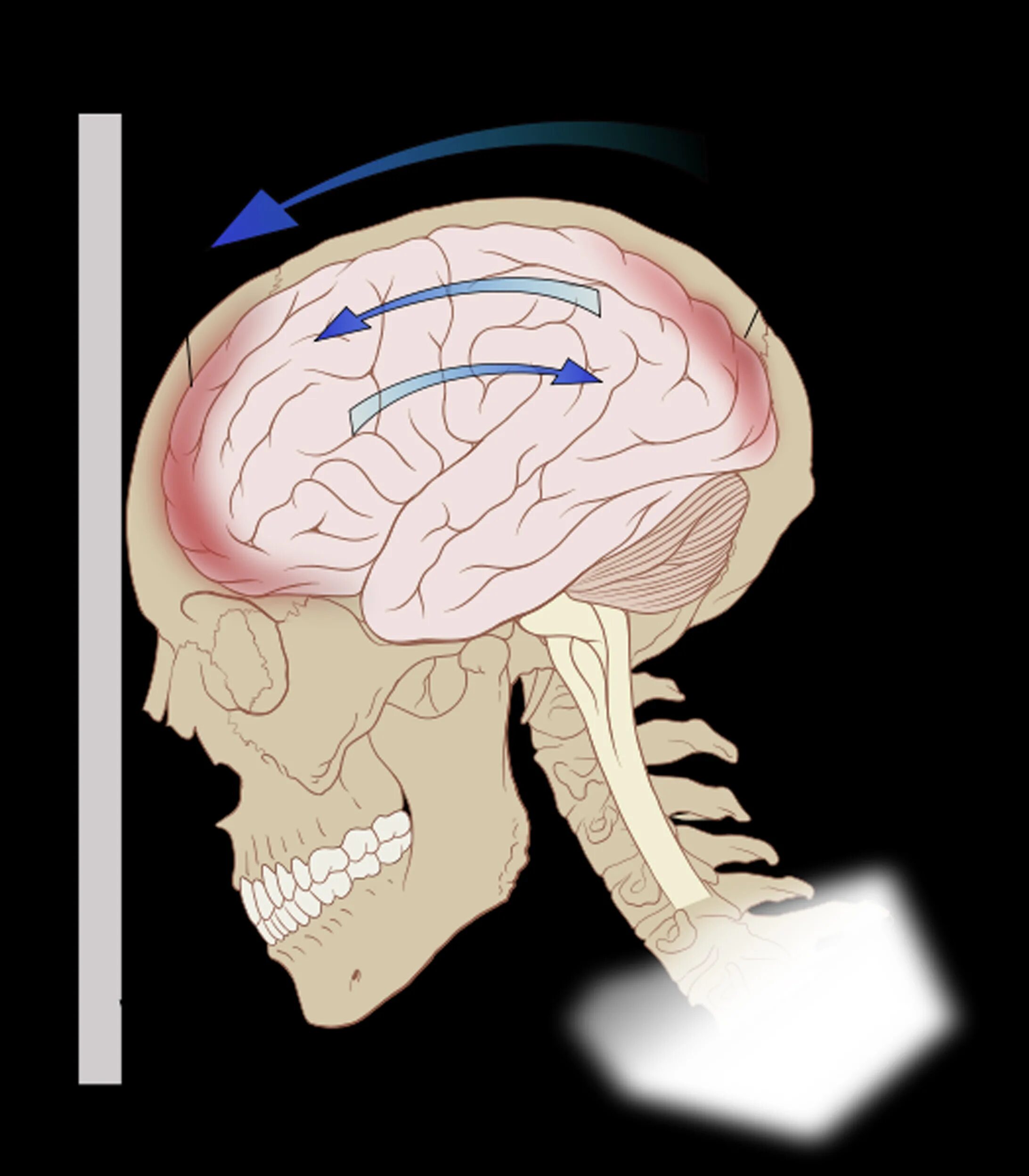 Traumatic brain. Черепно-мозговая травма удар противоудар. ЧМТ сотрясение головного мозга. Сотрясение черепно мозговая ушиб. Черепно-мозговая травма ушиб головного мозга.