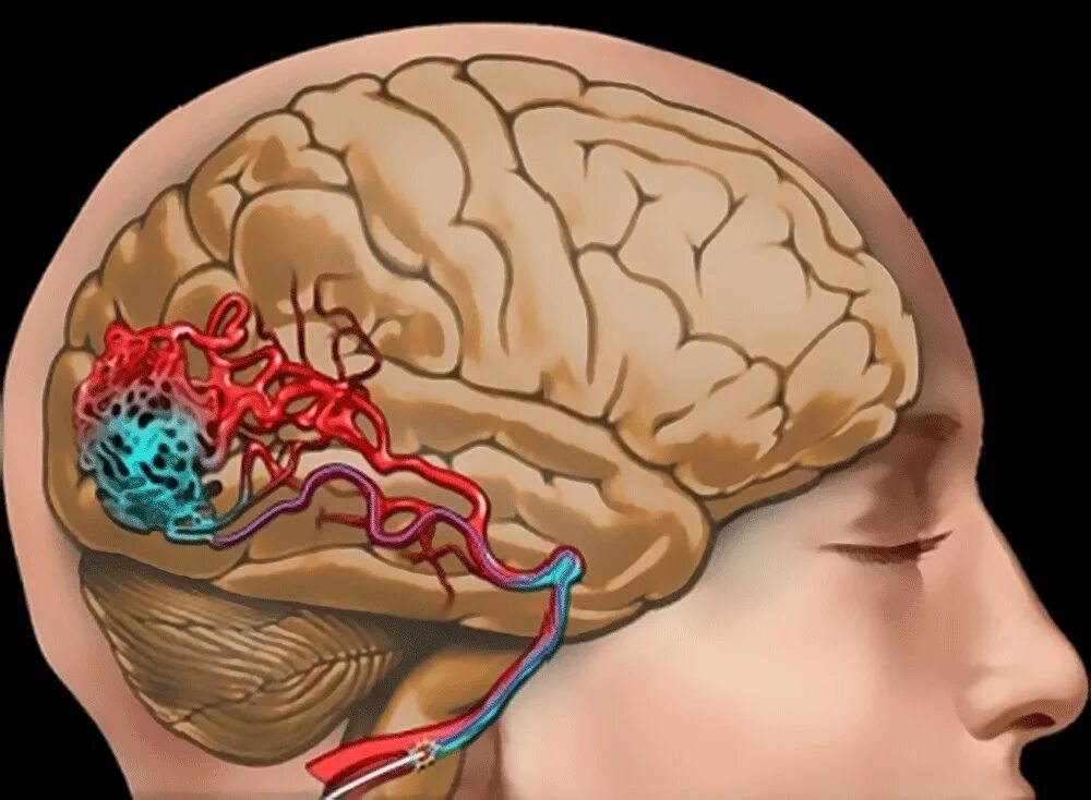 Brain g. Вена Галена мальформация. Мальформация сосудов головного мозга. Артериовенозная мальформация.