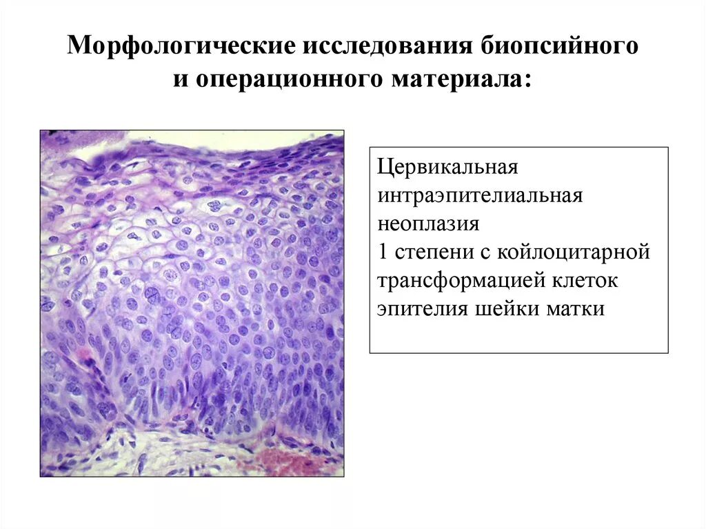 Интраэпителиальное поражение клетки