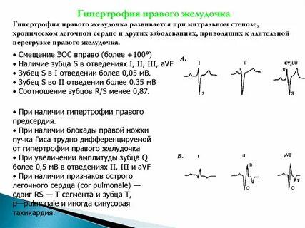 Гипертрофия правого желудочка сердца