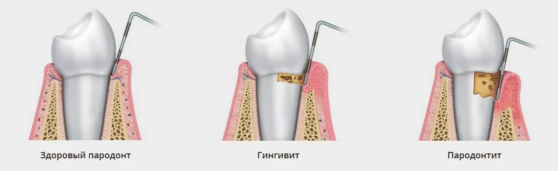Зубной карман. Пародонтит с глубиной зубодесневого кармана 5 мм. измерение пародонтальных карманов. пародонтальный костный карман это. эндодонто пародонтальные поражения.