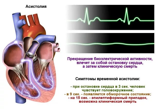 Асистолия. Асистолия сердца. Асистолия на ЭКГ. Причины асистолии сердца.