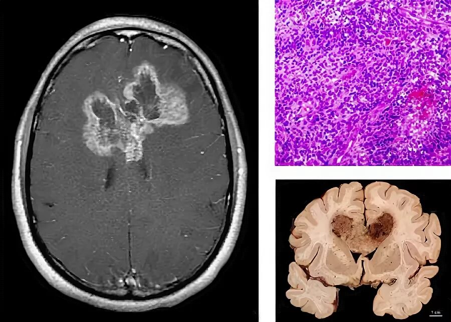 Анапластическая астроцитома кт. Глиобластома головного мозга гистология. Диффузная астроцитома кт.