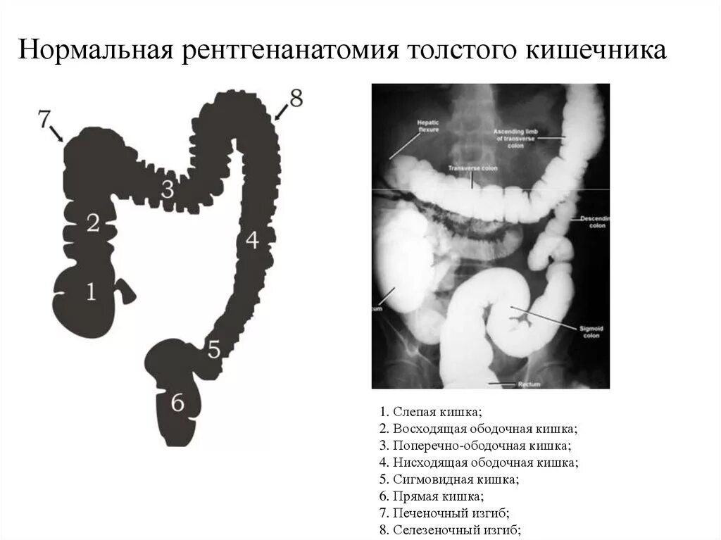 Анатомия сигмовидной кишки рентген. Анатомия толстой кишки рентген. Рентген анатомия Толстого кишечника. Слепая кишка рентген анатомия. Удлинена сигмовидной