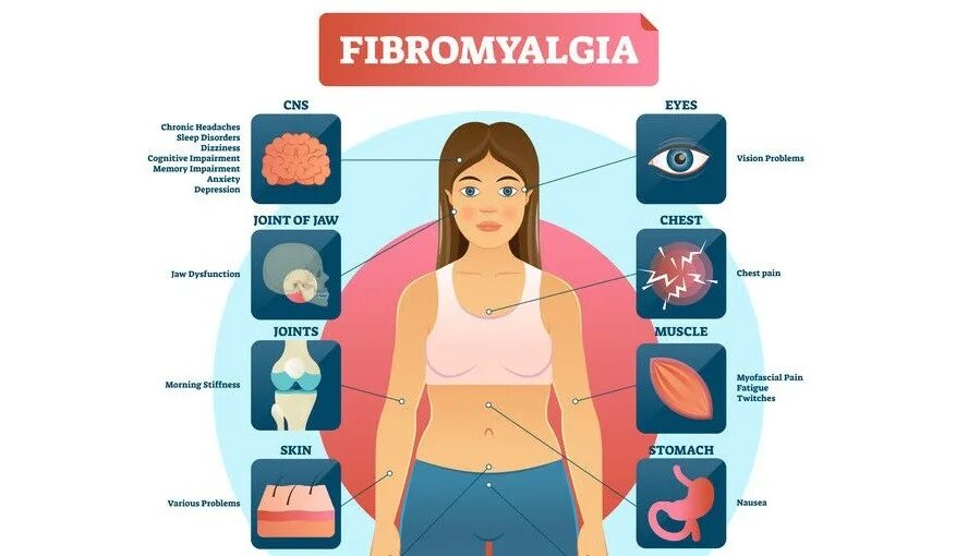Фибромиалгия у женщин лечение после 50. Фибромиалгия. Фибро алгия. Симптомы фибромиалгии. -Фибромиалгия (боль в мышцах).