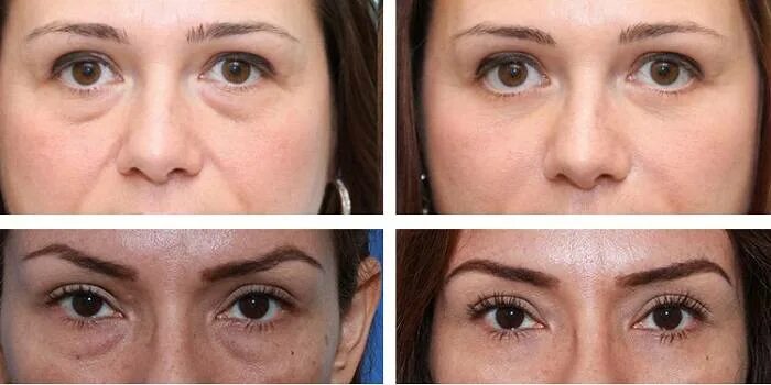 Лимфодренажный массаж глаз от отеков под глазами. Массаж от отечности век. Схема массажа лица от морщин. Лимфодренажный массаж от отеков под глазами. Массаж для снятия отека лица.