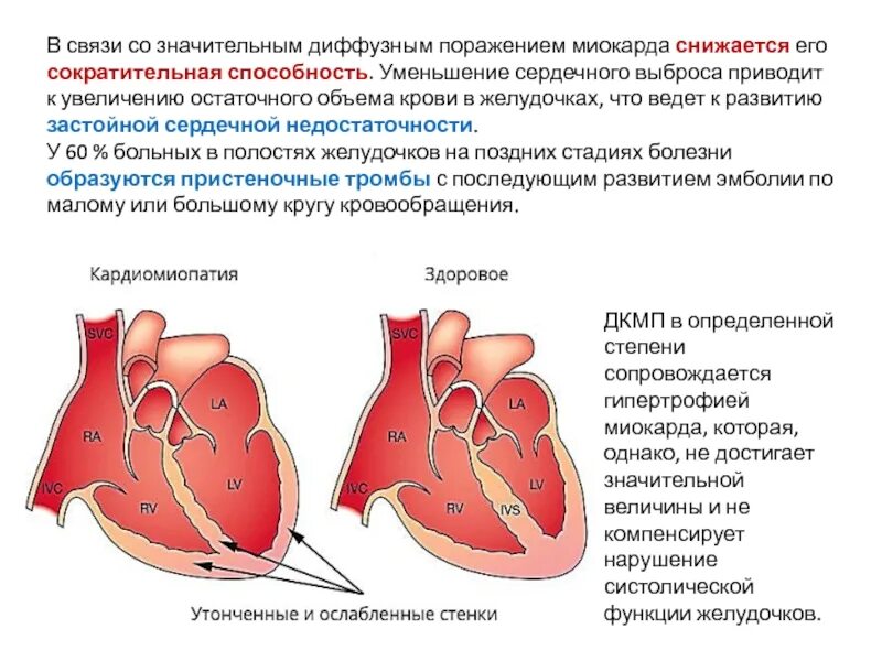 Диффузное снижение сократительной способности миокарда. Уменьшение объема левого желудочка сердца. Снижение сердечного выброса. Снижение сократительной способности сердца. Снижением сократимости