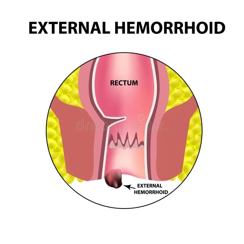Haemorrhoidectomy - Health Travellers Worldwide - Independent Health Advisory Me