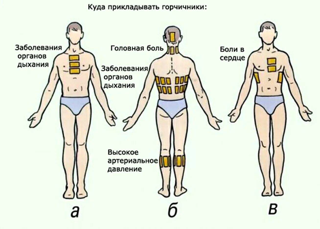 Как ставить горчичники при кашле детям. Схема постановки горчичников при бронхите. горчичники схема наложения. схема постановки горчичн ков при бронхите. схема накладывания горчичников.