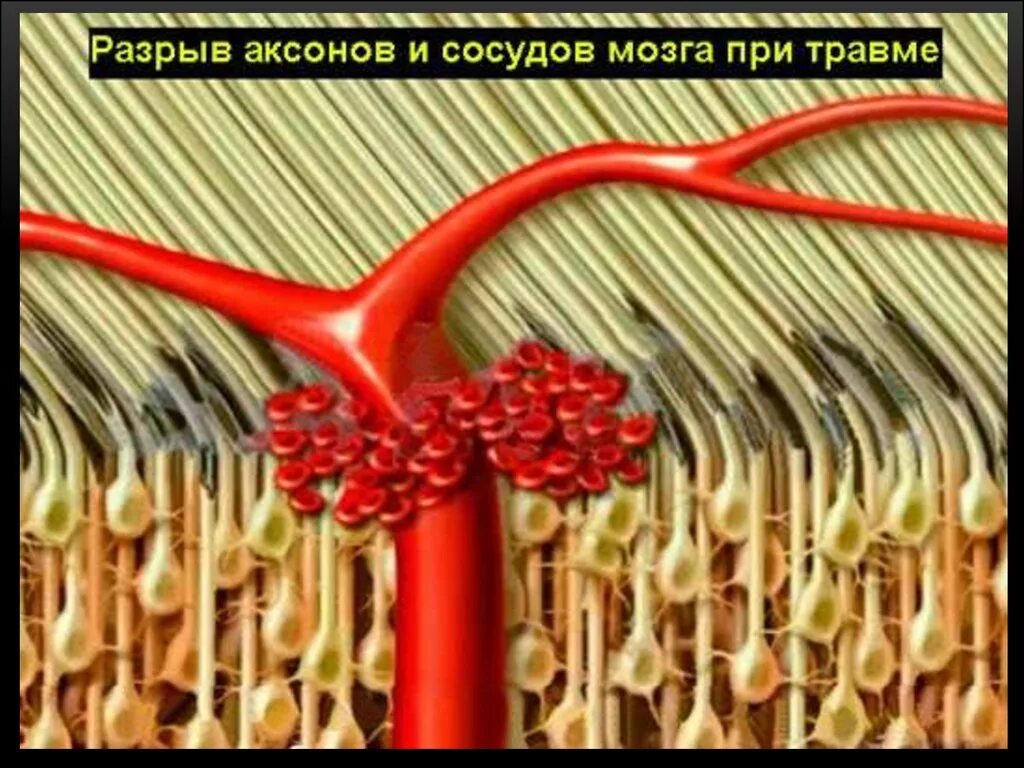 Диффузные повреждения. Разрыв аксонов головного мозга. диффузно аксональные повреждения головного мозга. диффузное повреждение аксонов.