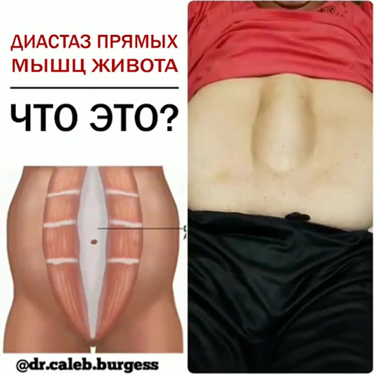 Как избавиться от диастаза мышц живота. Диастаз прямых мышц живота. расхождение прямых мышц живота. диастаз прямой мышцы живота. диастаз мышц брюшного пресса у ребёнка.