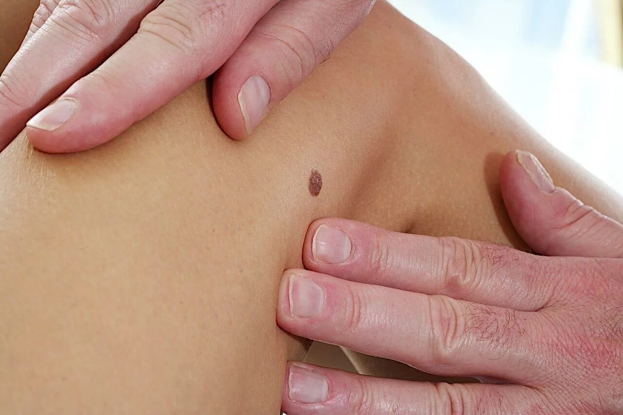 папилломы кожи удалить. хирургическое иссечение доброкачественных новообразований кожи. электрокоагуляция папиллом. электрокоагуляция папиллом. электрокоагуляция бородавки.