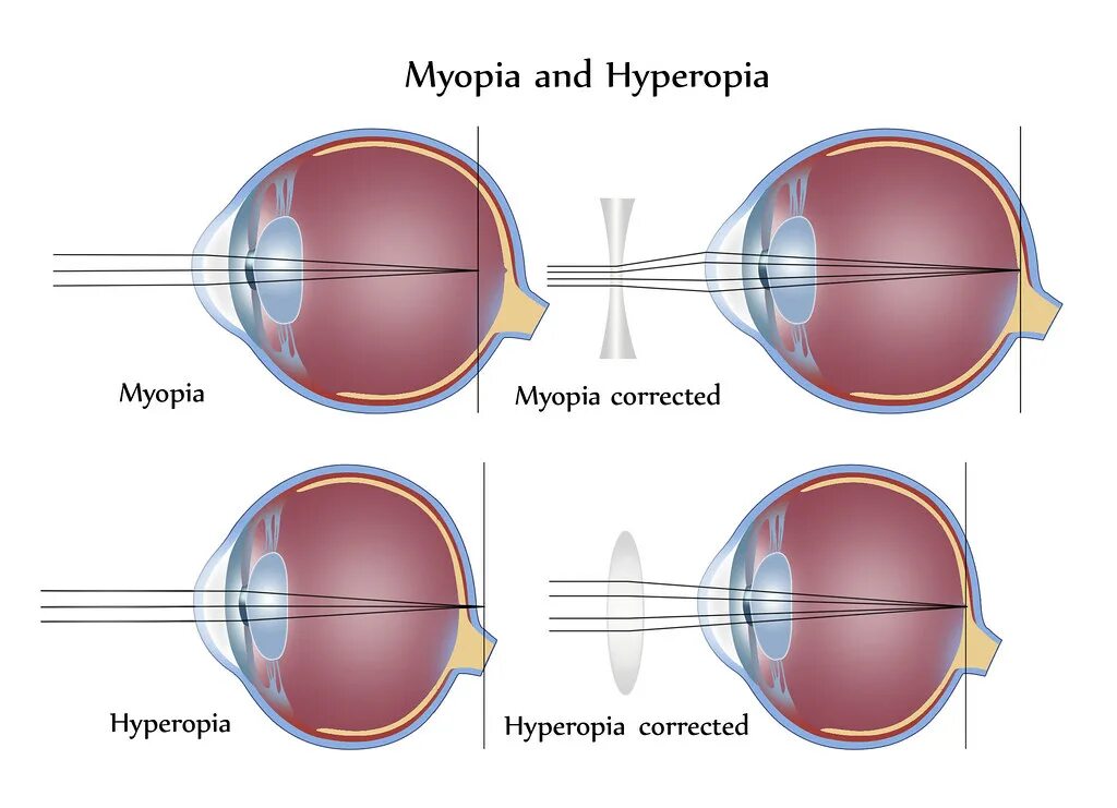 Линзы для зрения дальнозоркость. Близорукость и дальнозоркость. Заболевания глаз близорукость и дальнозоркость. Миопия и гиперметропия. Астигматизм и близорукость.