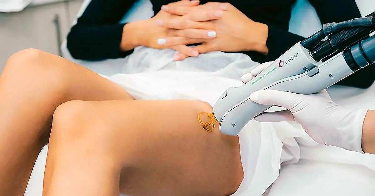 Лазерная эпиляция candela gentlelase. Александрийская эпиляция. Александритовый лазер кандела. Лазерная косметология (диодный лазер mediostar next германия). Александритовый лазер deka.