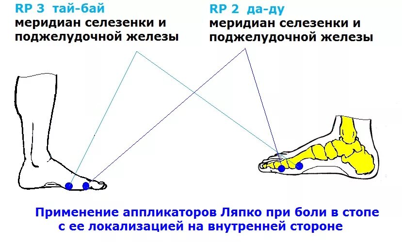 Подошва болит что делать