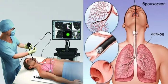 Бронхоскопия и бронхография. Гнойный эндобронхит на бронхоскопии. Бронхоскопия и биопсия легких. Туберкулез трахеи, бронхоскопия. В легкие через нос