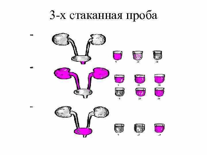 Двухстаканная проба мочи ,трехстаканная проба. Моча 3-х стаканная проба. Методика проведения трехстаканной пробы. Проведение трехстаканной пробы мочи. Трехстаканная проба мочи