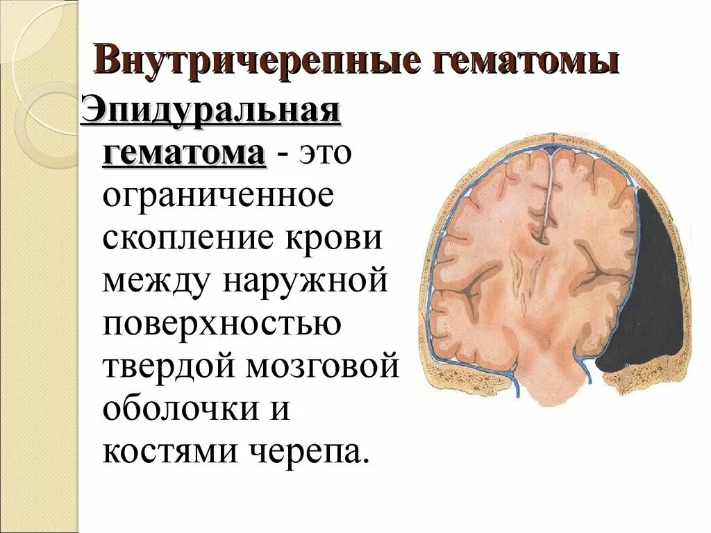 Гематома черепно мозговой травме