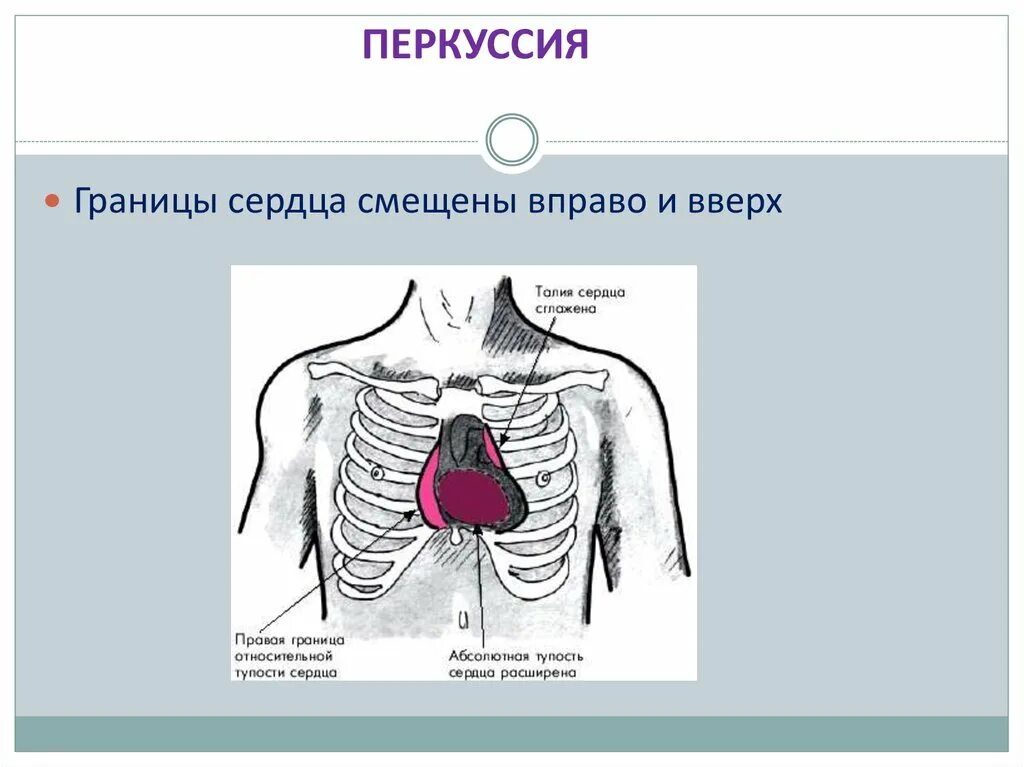 Расширение относительной тупости сердца. Перкуторное расширение границ сердца. Расширение границ относительной тупости сердца. Границы сердца пропедевтика внутренних болезней. Границы расширены влево