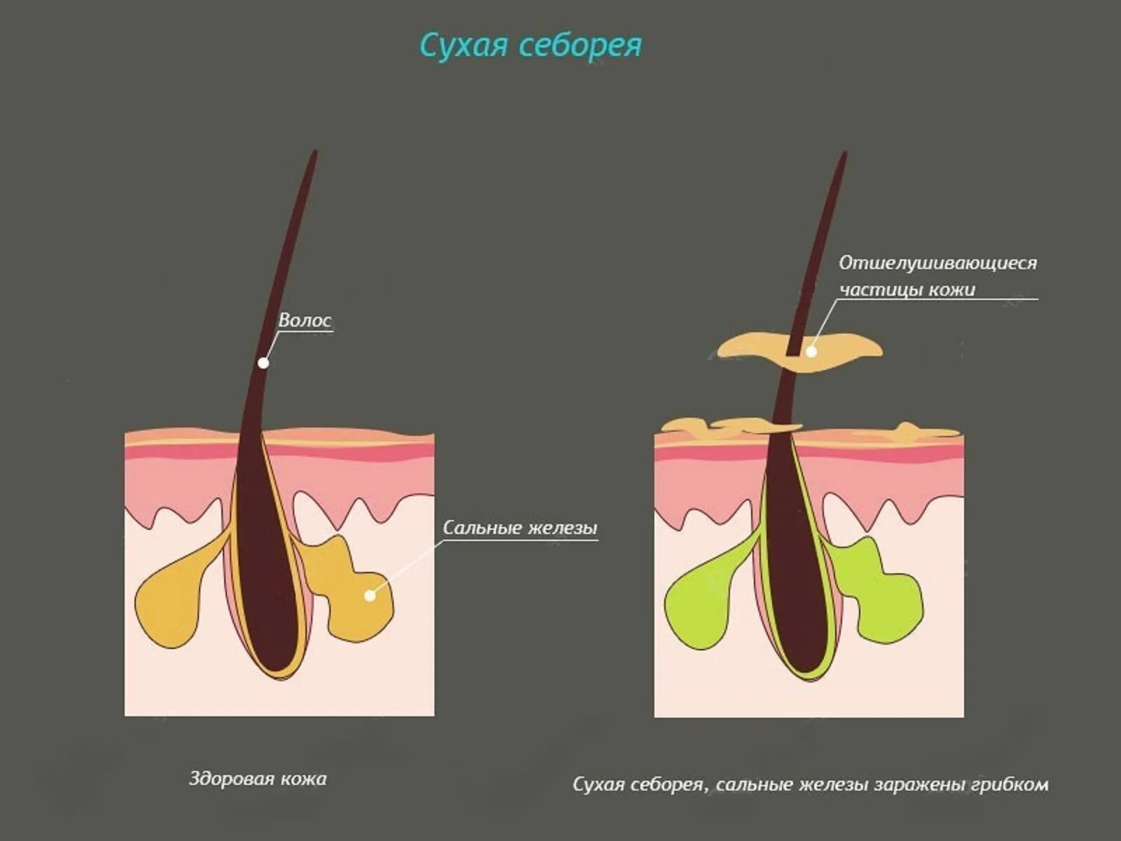 Сухая себорея. Сальные железы кожи головы. Сухой себорейный дерматит.