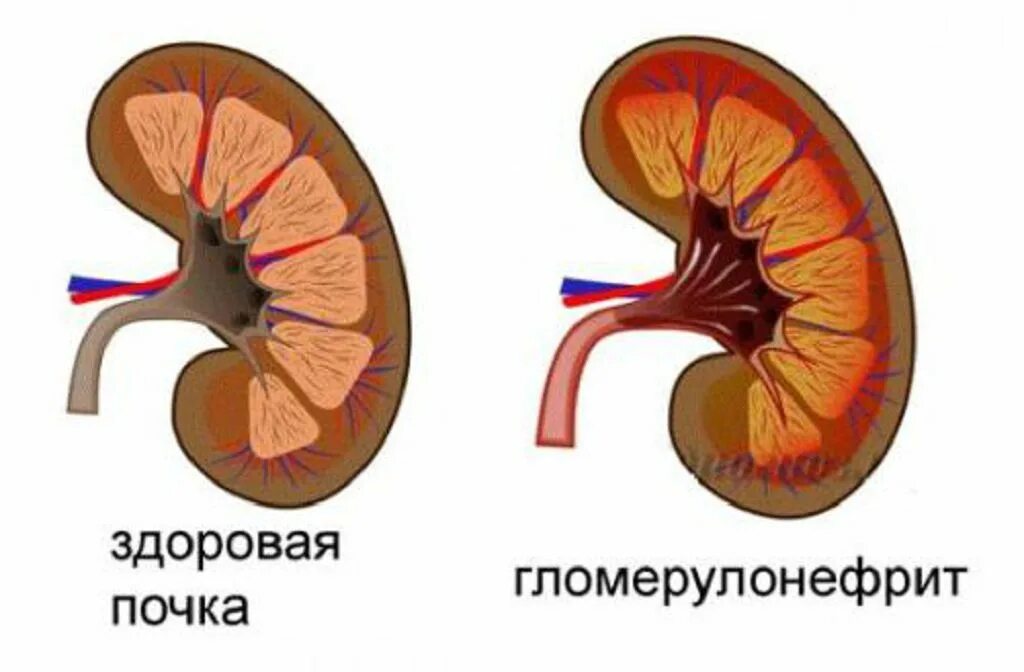 Гломерулонефрит здоровая и больная почка. Гломерулонефрит мочевыделительная система. Почка пораженная гломерулонефритом. Пиело и гломерулонефрит.