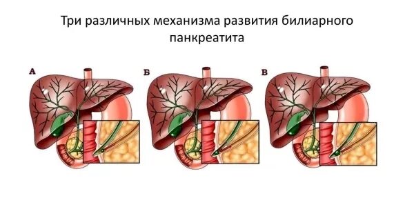 Хронический билиарнозависимый панкреатит. Желчнокаменный панкреатит. Острый билиарный панкреатит. Хронический Билиардно зависимый панкреатит. Хронический билиарный панкреатит