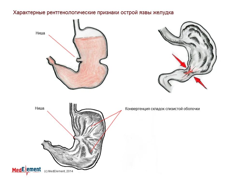 Острый желудок. Острый желудок. Характерные симптомы "острого живота". Острый желудок. Гипертрофический дуоденит.