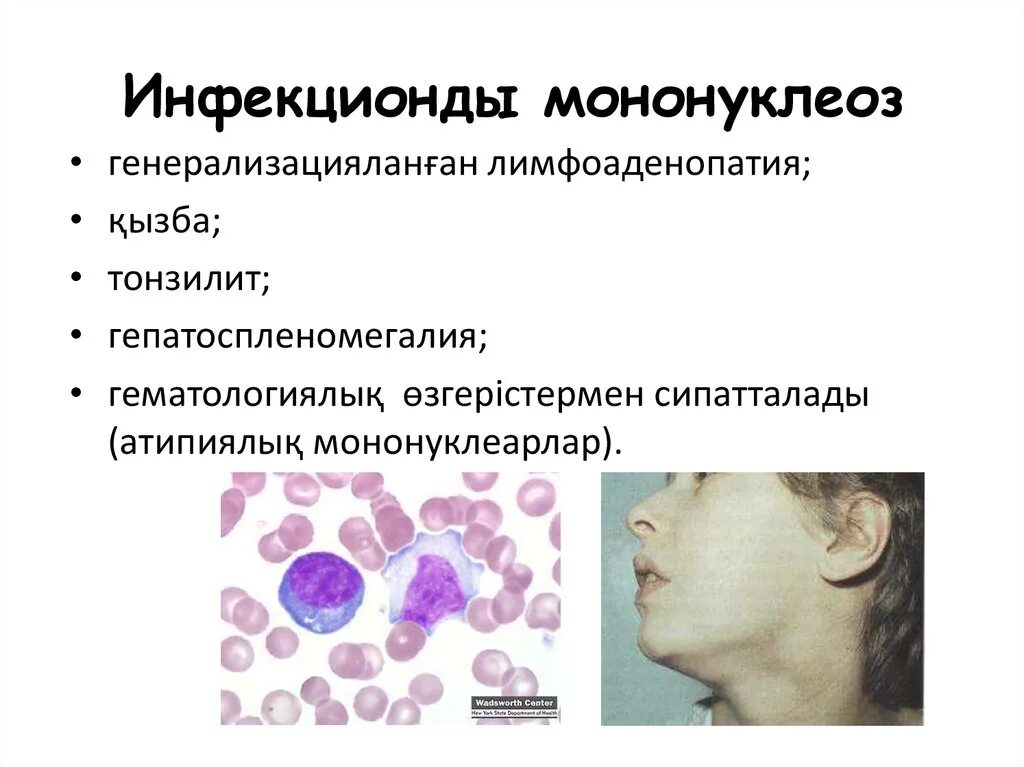 Мононуклеоз.[21. Клинические проявления мононуклеоза. Инфекционный мононуклеоз фарингоскопия. Инфекционный мононуклеоз пятна. Мононуклеоз у взрослых что это за болезнь