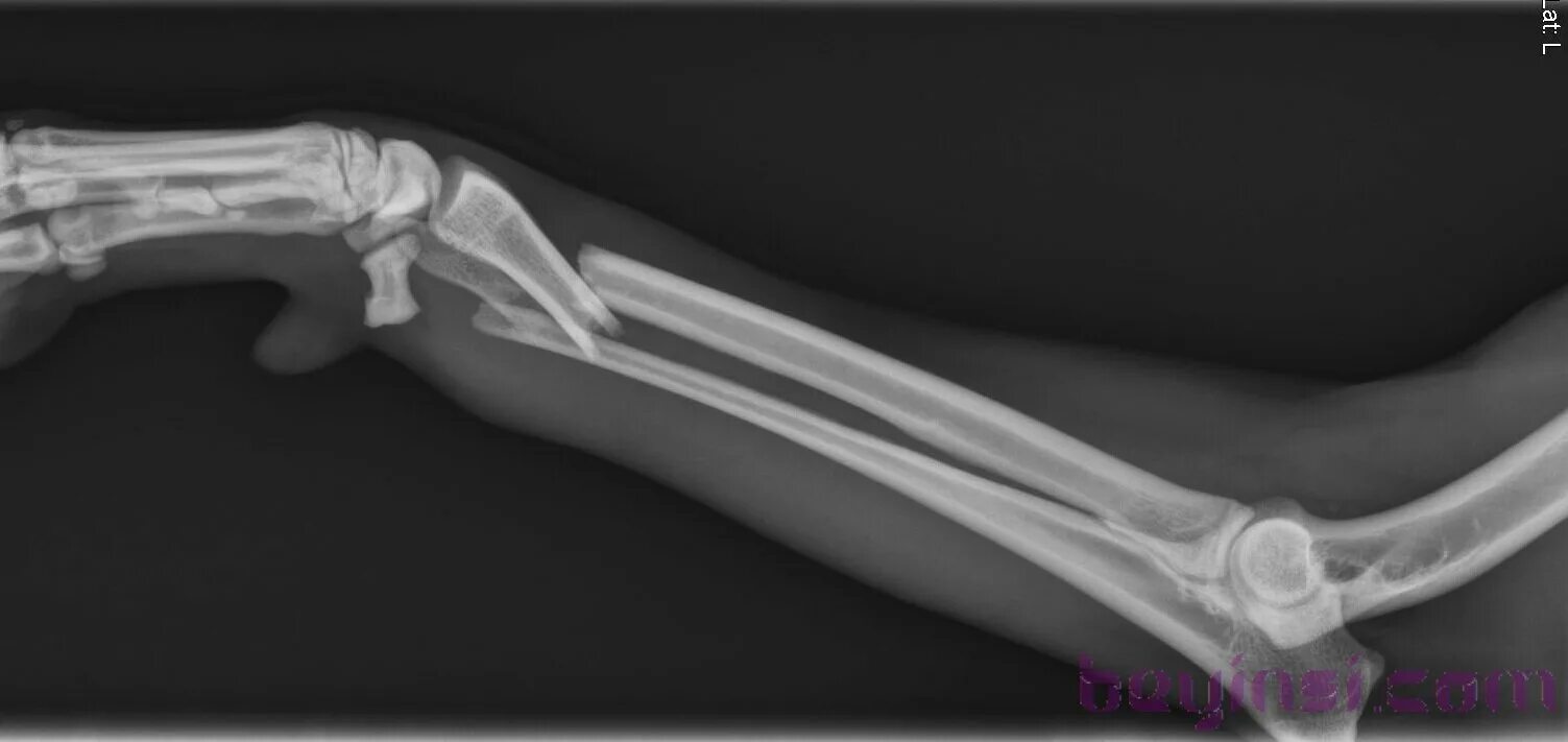 Открытый перелом кости руки. Переломы верхней конечности рентген. Перелом конечностей рентген. Остеосинтез костей кисти. Закрытый перелом со смещением рентген.