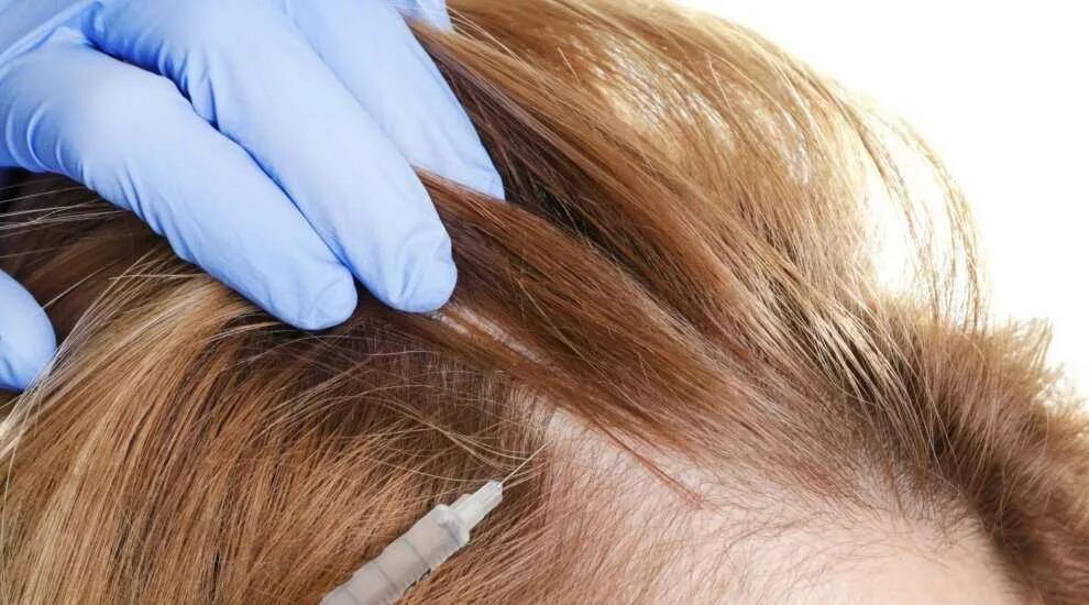 Мезотерапия кожи головы для чего. Мезотерапия кожи головы f hair. хаир комплекс мезотерапия для волос.