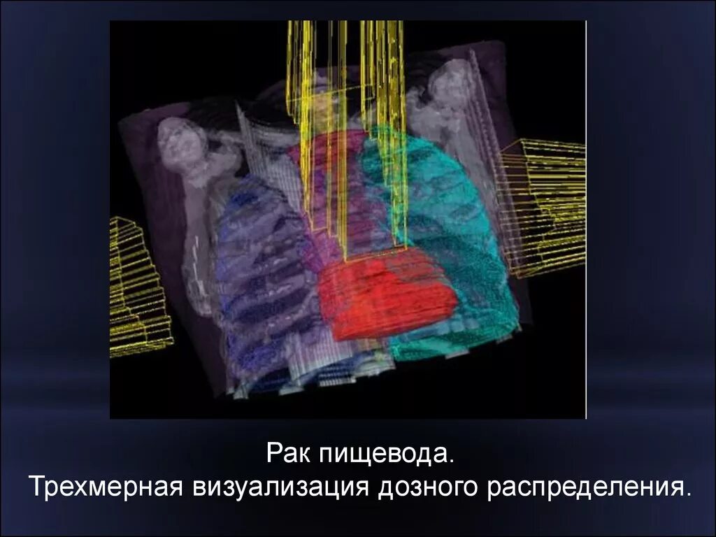 Лучевая пищевода. Лучевая терапия пищевода. Лучевая терапия при онкологии пищевода. Трехмерная конформная лучевая терапия. Внутрипросветная лучевая терапия пищевода.