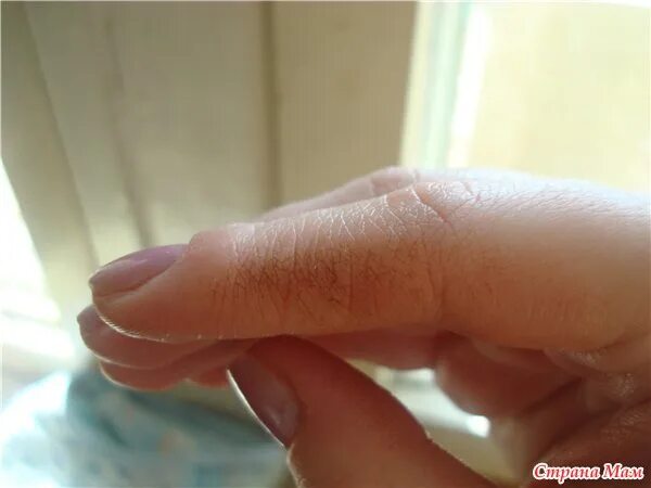 прыщик на пальце у ребенка. сохнут указательные пальцы. сохнут указательные пальцы. маленькие прыщи на пальцах. ламеллярный дисгидроз.