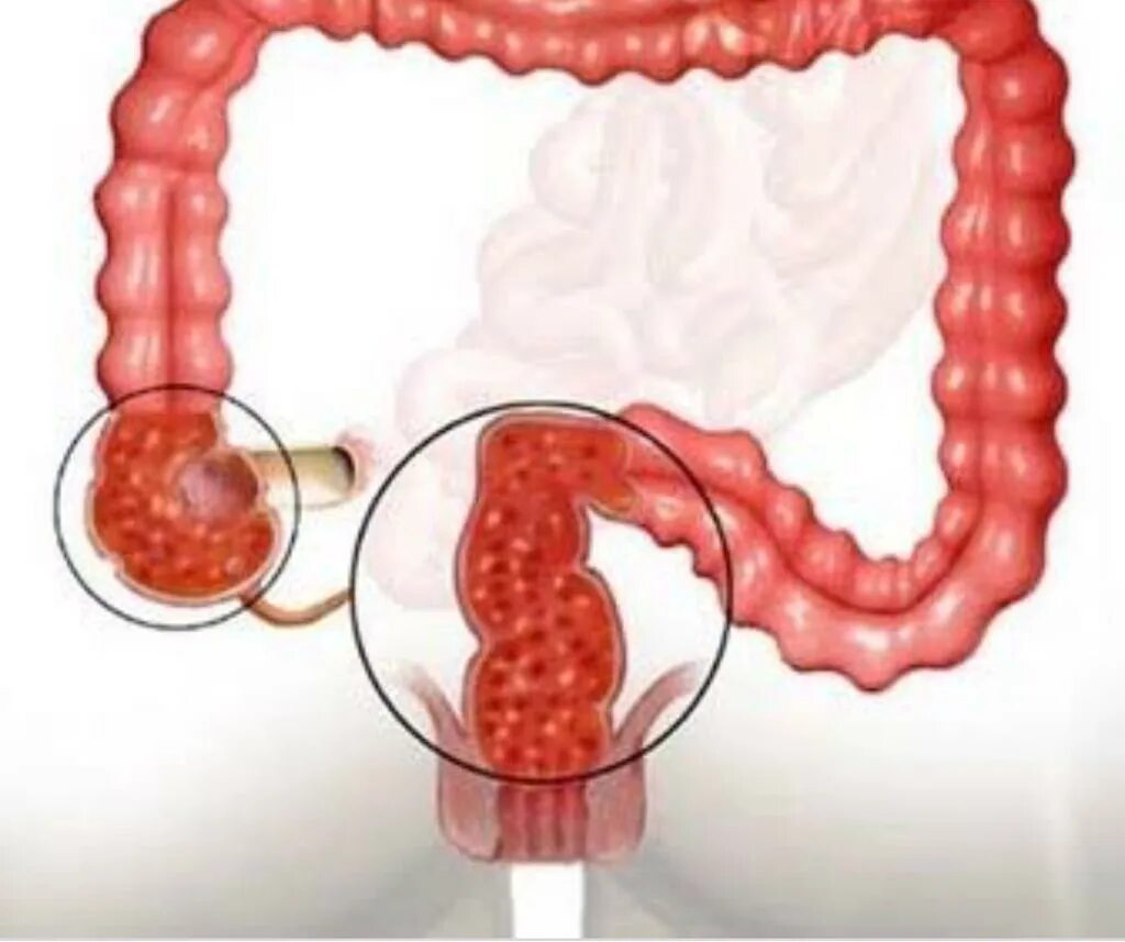 Молочница в кишечнике. Язвенный колит проктосигмоидит. Язвенный колит толстой кишки. Хронический колит толстой кишки. Язвенный колит проктит.
