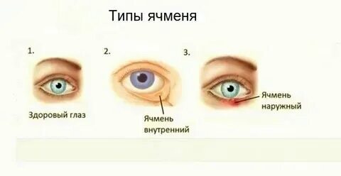 Болит ли ячмень