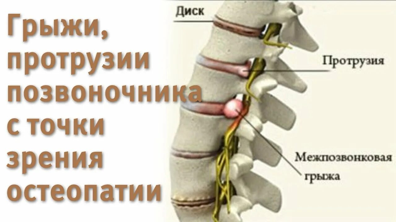 Протрузия диска с3 с4 шейного отдела позвоночника. Защемление диска позвоночника. Протрузия межпозвонковых дисков. Защемление грудного позвонка.