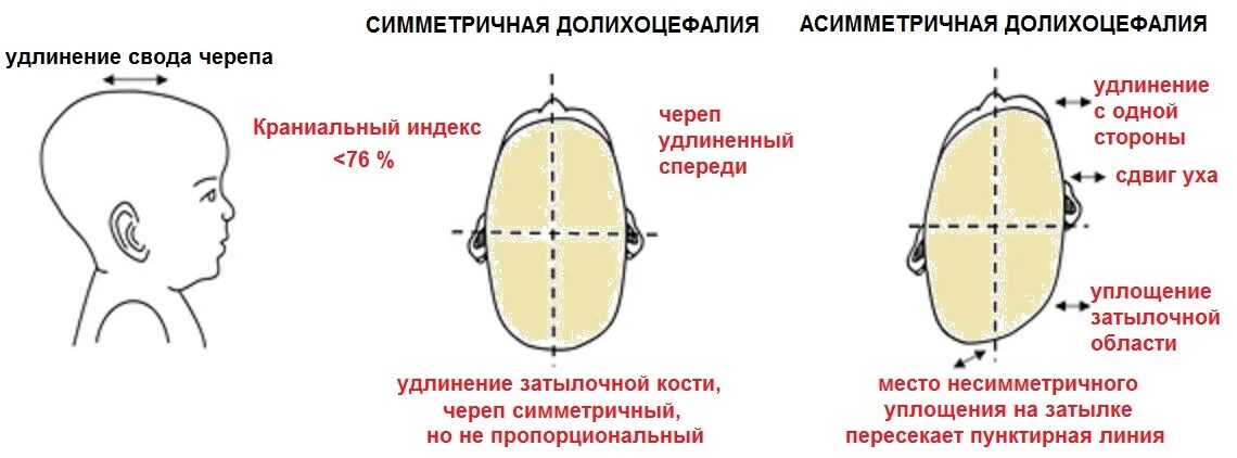 Варианты формы черепа. Форма головы сбоку младенца. Форма головы у новорожденных брахицефалическая это. Формы головы у новорожденных долихоцефалия.