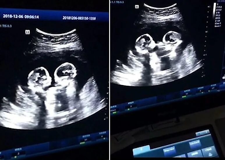 УЗИ двойни на 20 неделе беременности. УЗИ 12 недель беременности двойня. УЗИ 15 недель беременности двойня. Двойняшки на УЗИ 12 недель беременности. Двойня 26 недель