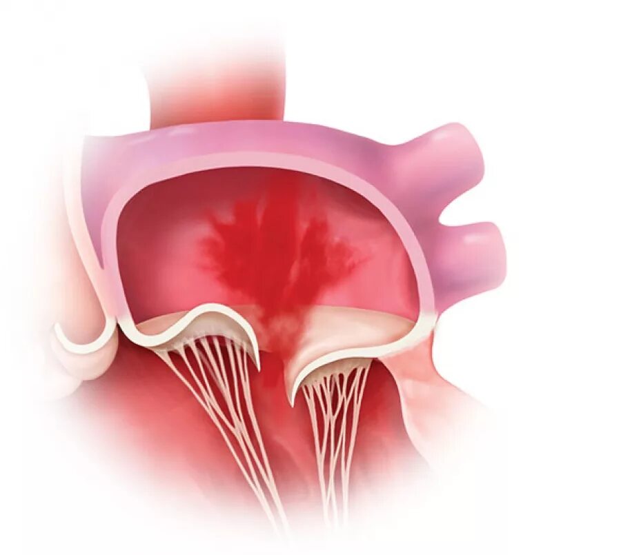 Что такое пролапс митрального клапана. Пролапс митрального клапапан. Парашютообразный митральный клапан. Операция пролапс митрального.