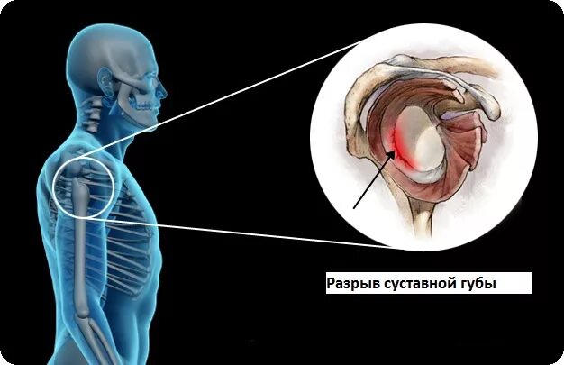 Отдел разрыв. Фиброзно-хрящевая губа гленоида. Верхний сегмент суставной губы плечевого сустава. Повреждение суставной губы гленоида. Фиброзно хрящевая губа гленоида лопатки.