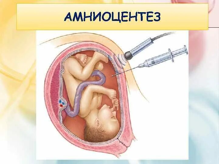 Фетальная хирургия. Пункция околоплодных вод. Амниотомия (вскрытие плодного пузыря). Исследование околоплодных вод амниоцентез. Трансабдоминальный амниоцентез показания.