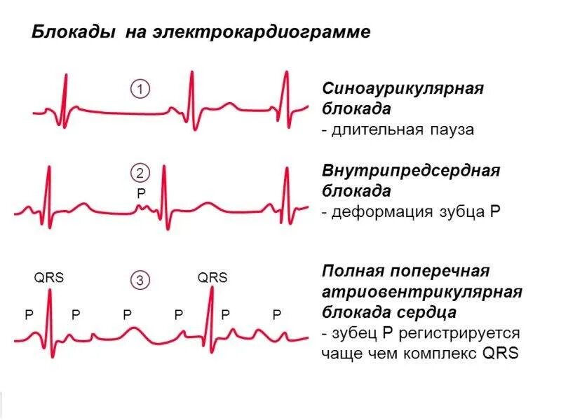 Что означает блокада сердца. Внутрипредсердная блокада на экг. как выглядит блокада на экг. блокады на экг расшифровка. нарушение проводимости блокады экг.