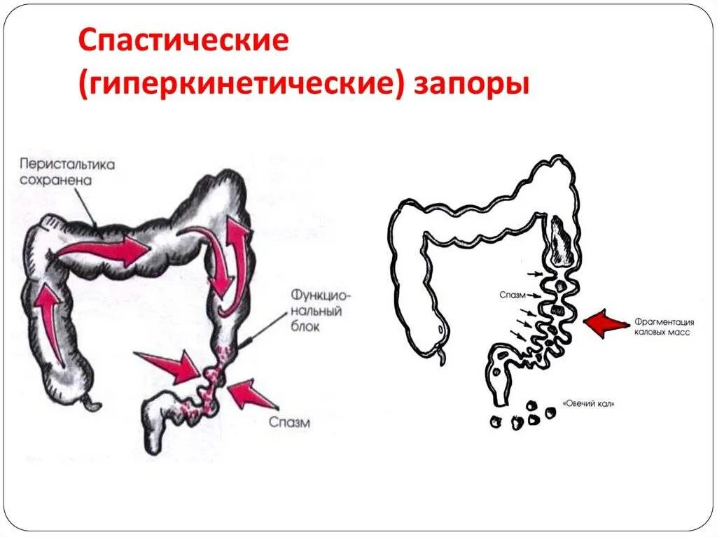 Почему запоры что делать. Спастический запор. Спазматический запор. Спастическое сокращение кишечника. Атонический и спастический запор.