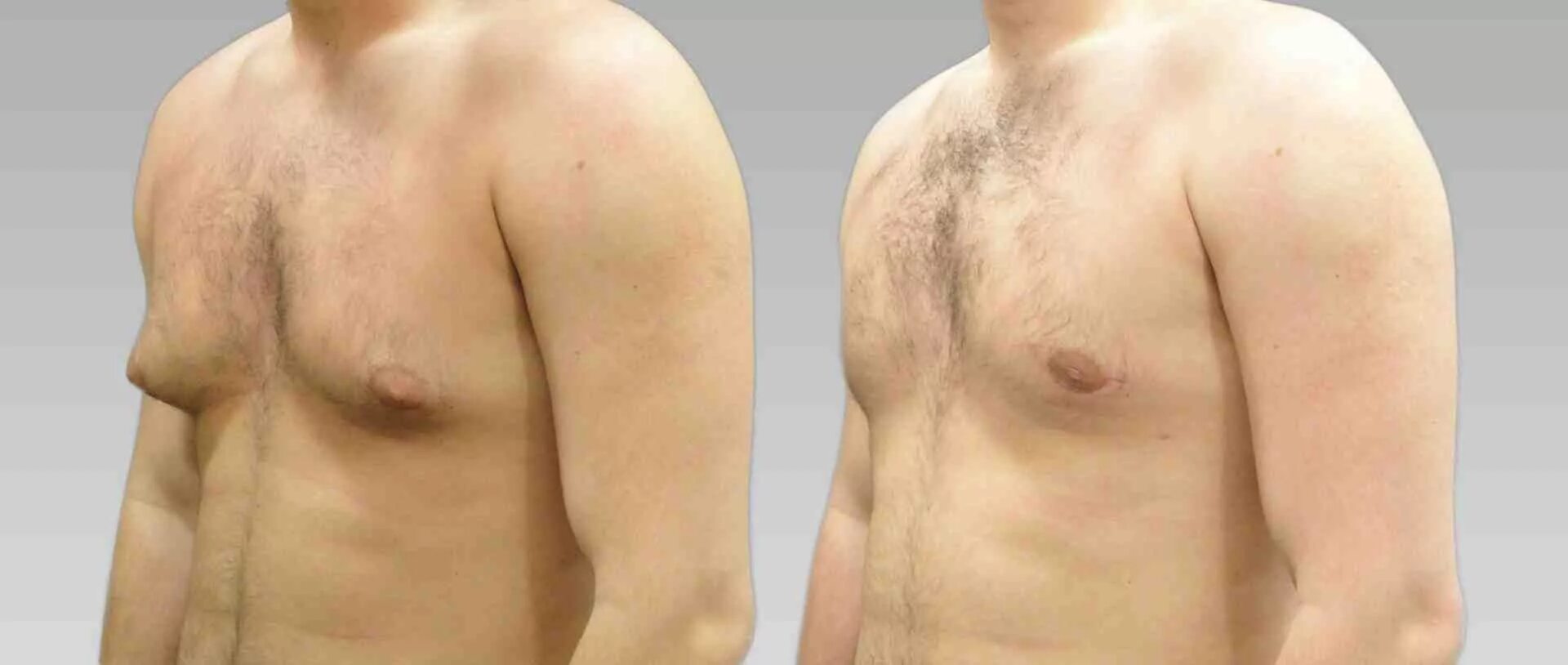 Маленькая гинекомастия. Гинекомастия до и после операции. Радикальная мастэктомия по холстеду. Удаление молочной железы топографическая анатомия. Резекция молочной железы.