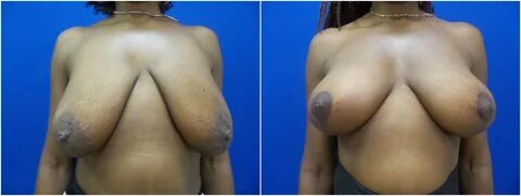 Augmentation Mastopexy (Breast Lift) Photos.