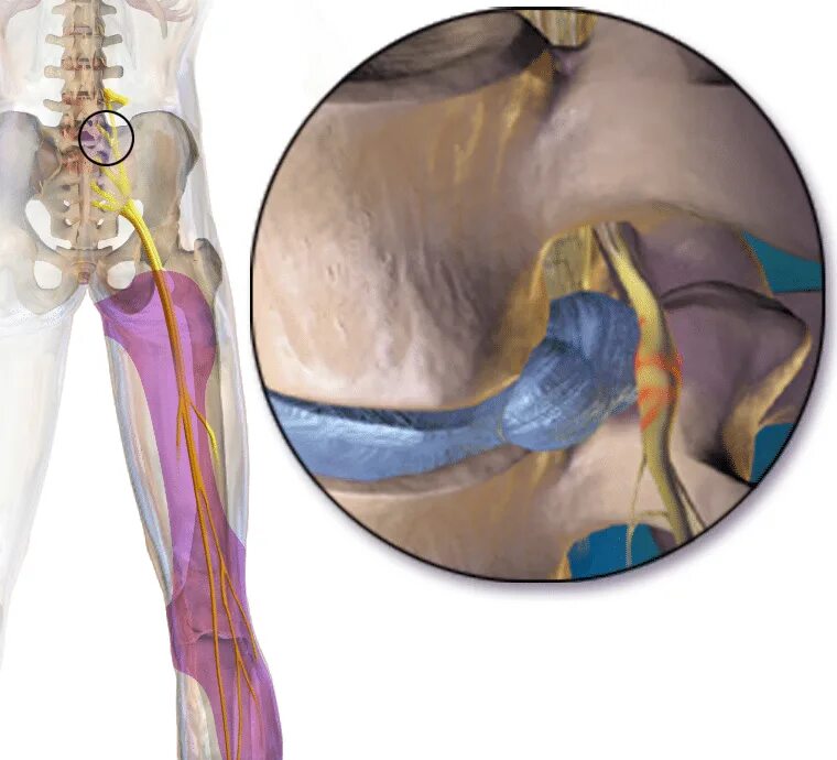 Ишиас воспаление седалищного. Защемление седалищного нерва. Ишиас седалищного нерва симптомы. Защемление седалищного нерва анатомия.