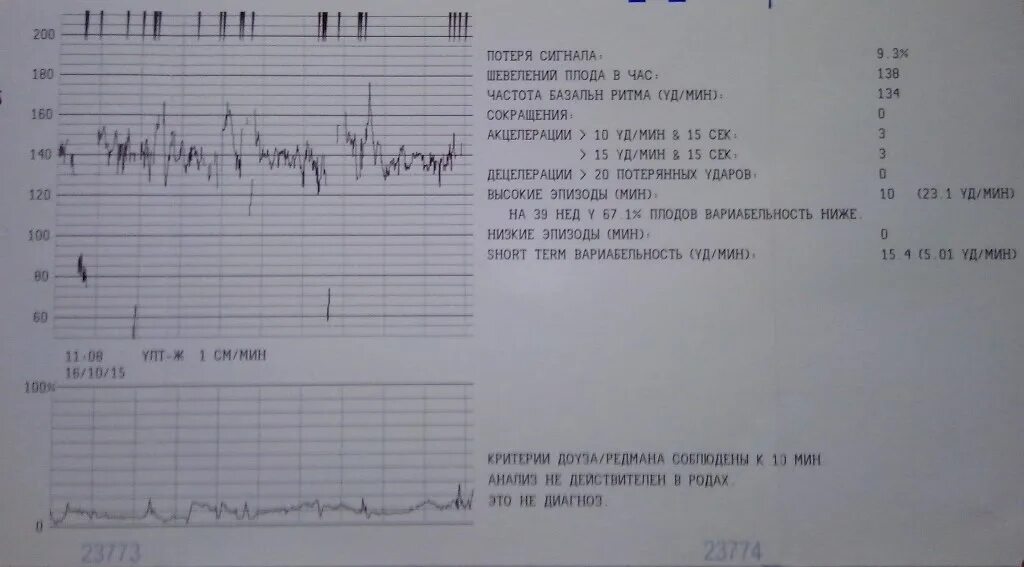 Шевеления плода ощущения. Норма КТГ В 33 недели. КТГ норма 34 неделя беременности норма. Ундулирующий ритм на КТГ. Норма КТГ на 37 недели беременности.