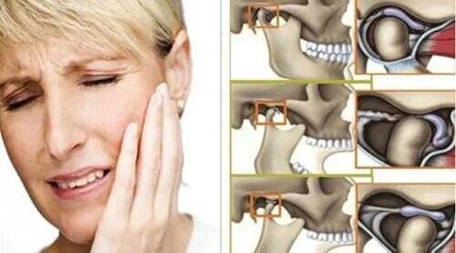 Щелкает челюсть при открытии рта что делать. Травматический артрит ВНЧС. Челюстью(дисфункция ВНЧС). Артрит височно-нижнечелюстного сустава симптомы. Эндопротезирование височно-нижнечелюстного сустава (ВНЧС).